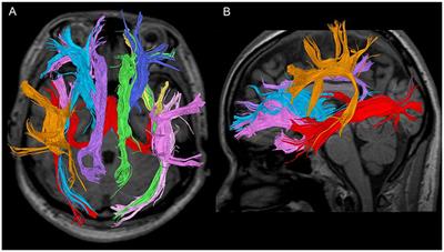 Comparison of White Matter Structure of Drug-Naïve Patients With Bipolar Disorder and Major Depressive Disorder Using Diffusion Tensor Tractography